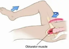 Diagnosing for appendicitis: obturator sign - Healthsoothe