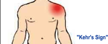 What does it mean to have kehr's sign - Healthsoothe