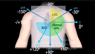 Left Axis Deviation - Healthsoothe