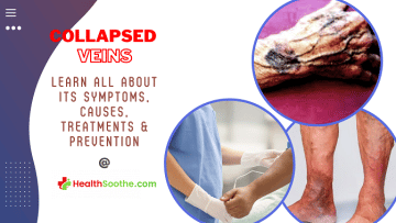 Collapsed vein - Healthsoothe