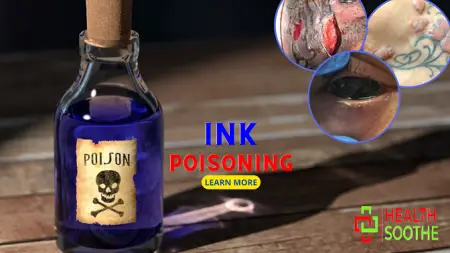 ink poisoning - Healthsoothe