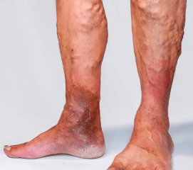 Potential Complications Of A Collapsed Vein - Healthsoothe