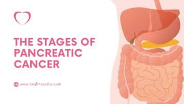 The Stages of Pancreatic Cancer