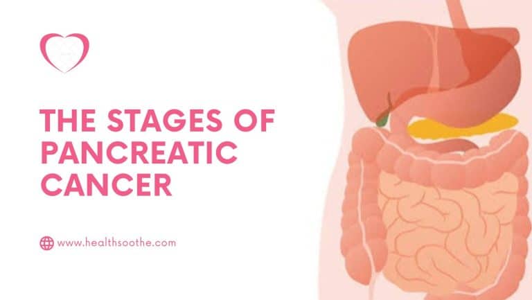 The Stages of Pancreatic Cancer
