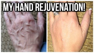 Treatment of Collapsed Vein - Healthsoothe