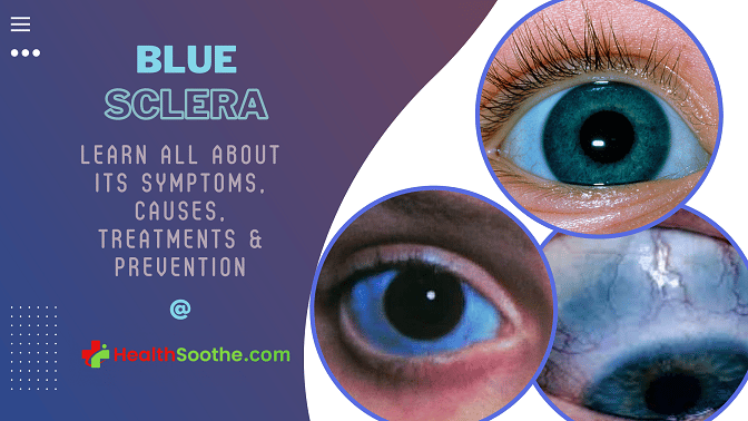blue sclera - Healthsoothe