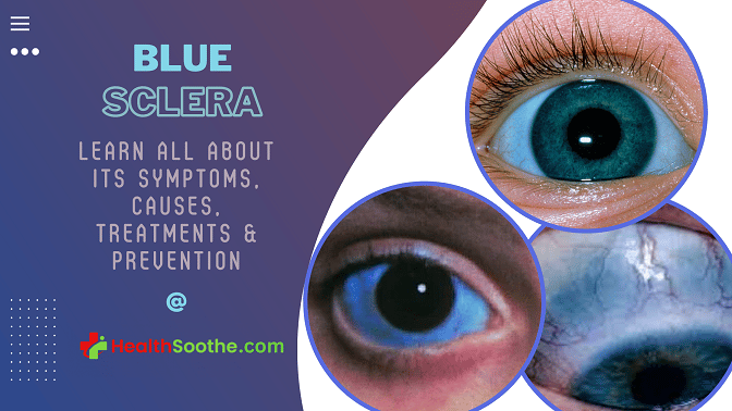 Blue Sclera - Healthsoothe