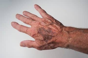 What causes collapsed vein - Healthsoothe