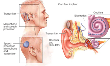 what causes musical ear syndrome: cochlea implant - Healthsoothe