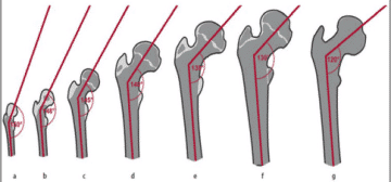 The Embryology And Formation Of The Trochanter - Healthsoothe