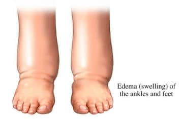 heat edema - Healthsoothe