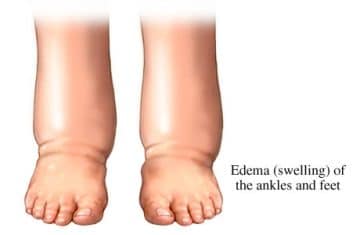 Heat Edema - Healthsoothe