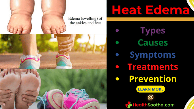 heat edema - Healthsoothe