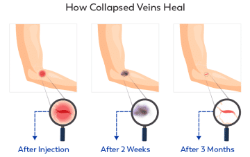 How Long Does It Take A Collapsed Vein To Heal - Healthsoothe