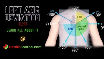 left axis deviation - Healthsoothe