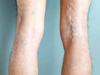 collapsed vein: permanent vein collapse - Healthsoothe