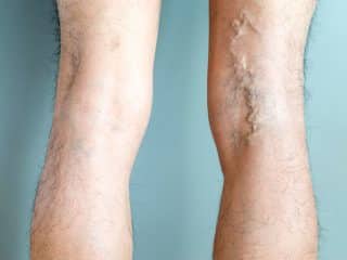 Collapsed Vein: Permanent Vein Collapse - Healthsoothe