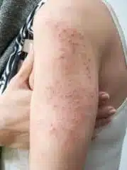 Ink Poisoning: Symptoms Causes Treatment And Pictures