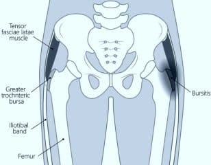 The trochanter: Trochanteric Bursitis - Healthsoothe