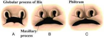 Development Of The Philtrum - Healthsoothe