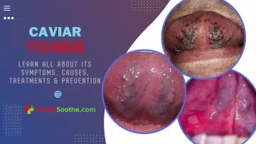 caviar tongue - Healthsoothe