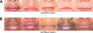 Variations of the Philtrum - Healthsoothe