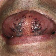 caviar tongue - Healthsoothe
