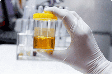 Epithelial Cells In Urine Test - Healthsoothe