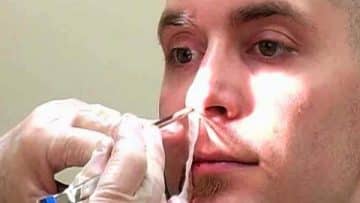Nose Cauterization - Healthsoothe