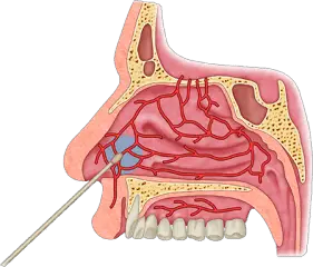 procedure of nose cauterization - Healthsoothe