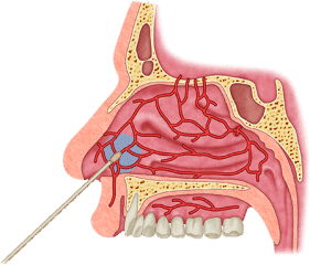 Procedure Of Nose Cauterization - Healthsoothe