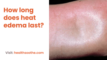 How long does heat edema last