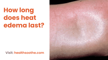 How Long Does Heat Edema Last