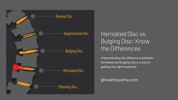 Herniated Disc vs. Bulging Disc: Know the Differences