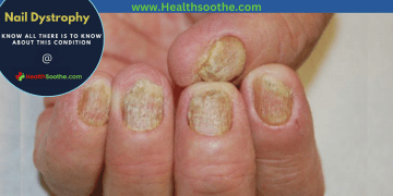 Nail Dystrophy - Healthsoothe