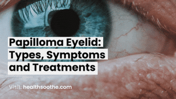 Papilloma Eyelid_ Types, Symptoms And Treatments