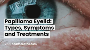 Papilloma Eyelid_ Types, Symptoms and Treatments
