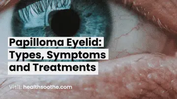 Papilloma Eyelid_ Types, Symptoms and Treatments