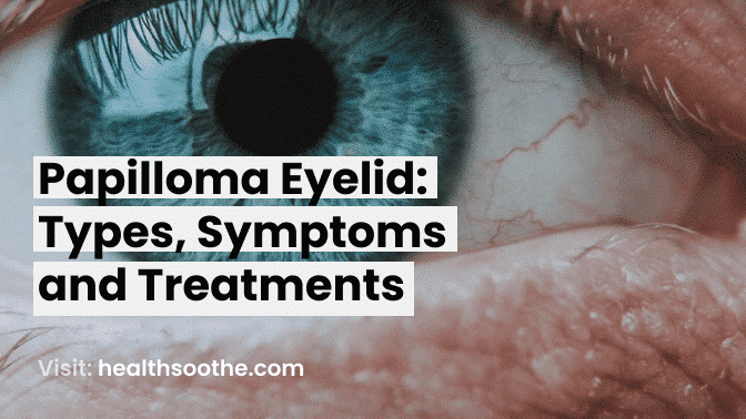 Papilloma Eyelid_ Types, Symptoms And Treatments