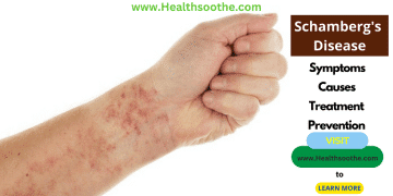 Schamberg Disease - Healthsoothe