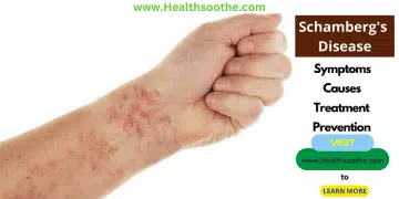 Schamberg disease - Healthsoothe