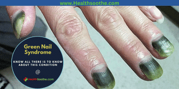 green nail syndrome - Healthsoothe