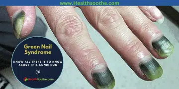 green nail syndrome - Healthsoothe