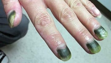 green nail syndrome - Healthsoothe