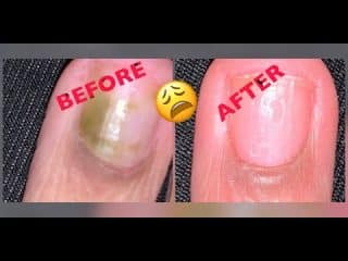 Green Nail Syndrome Treatment - Healthsoothe