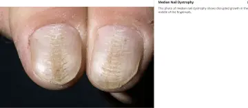 median nail dystrophy