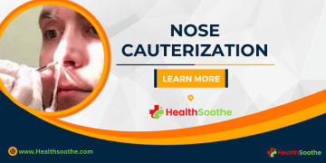 Nose cauterization - Healthsoothe