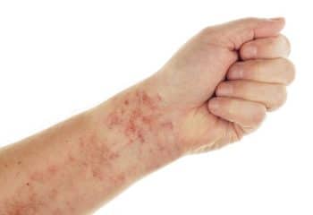 schamberg disease - Healthsoothe