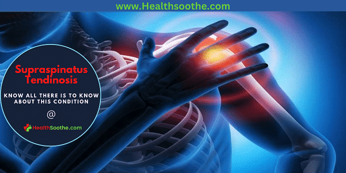 Supraspinatus Tendinosis - Healthsoothe