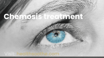 Https://Www.healthsoothe.com/Wp-Content/Uploads/2023/01/Chemosis-Treatment.png